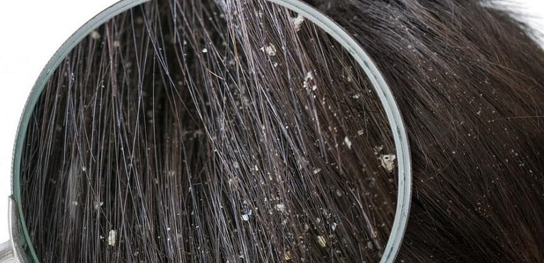 Get Rid Of Dandruff