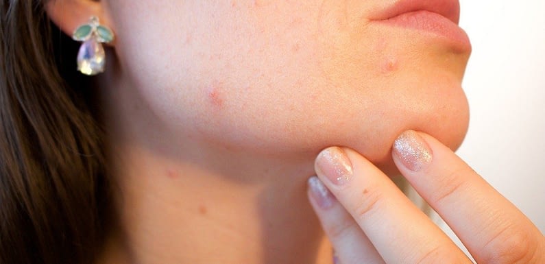 Get Rid Of Pimples – Best Natural Ways
